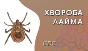 Як не захворіти, якщо вкусив кліщ?