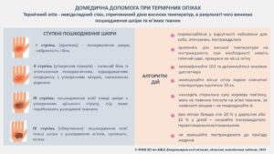 Пам'ятка на тему: " Домедична допомога при термічних опіках"